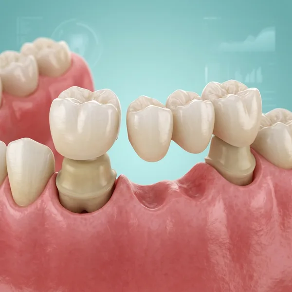 Premium Crowns and Bridges Dental Restoration in Gudivada - Krishna Dental
