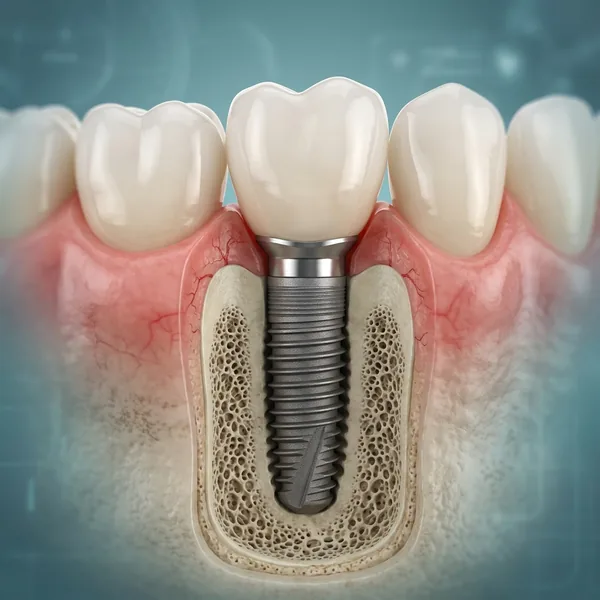 Permanent Titanium Dental Implants in Gudivada - Krishna Dental