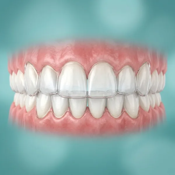 Braces vs. Clear Aligners after successful treatment - Patient #01 at Krishna Dental Gudivada
