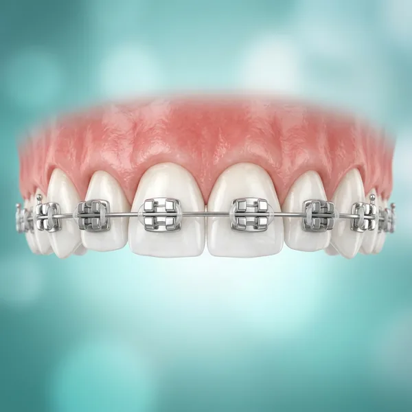 Braces vs. Clear Aligners before treatment - Patient #01 at Krishna Dental Gudivada